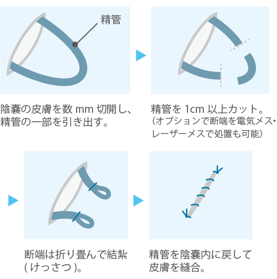 有楽町美容外科クリニック パイプカットをお考えの方に